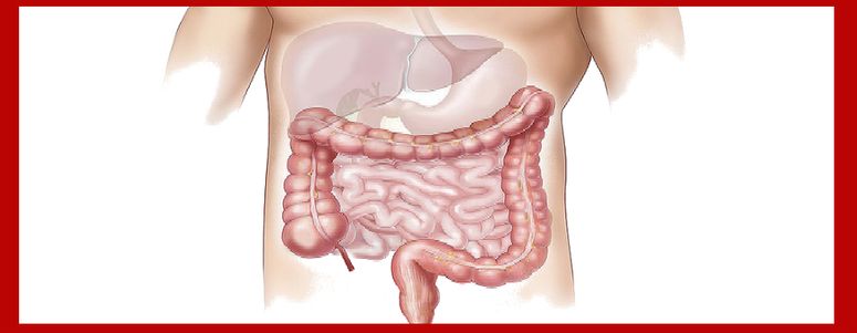 Enfermedad Inflamatoria Intestinal