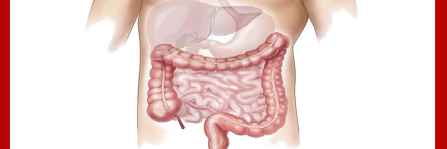 Enfermedad Inflamatoria Intestinal