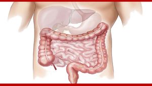 Enfermedad Inflamatoria Intestinal